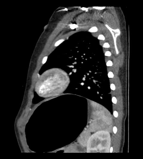 Coarctation of aorta (Radiopaedia 27427-27622 Sagittal C+ CTPA 111).png
