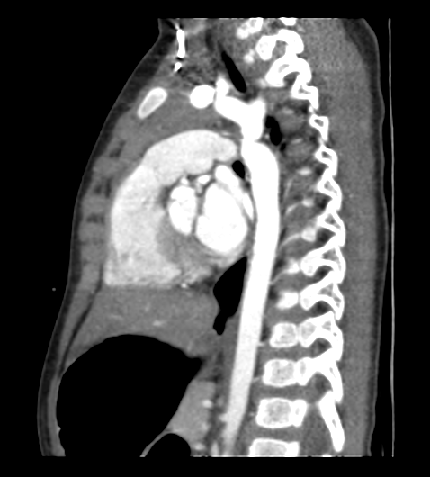 File:Coarctation of aorta (Radiopaedia 27427-27622 Sagittal C+ CTPA 74).png