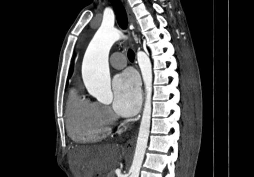 Coarctation of aorta with aortic valve stenosis (Radiopaedia 70463-80574 B 63).jpg