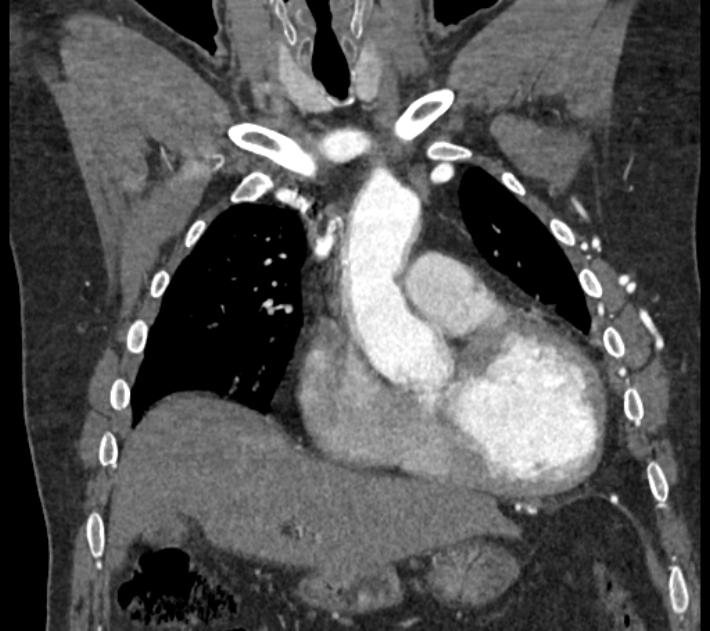 Coarctation of the aorta (Radiopaedia 53752-59822 B 27).jpg