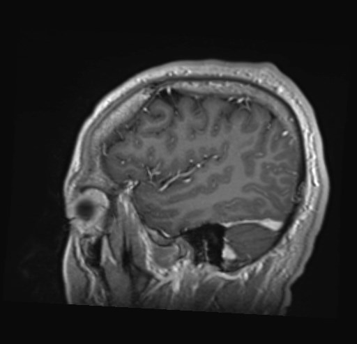 File:Cochlear incomplete partition type III associated with hypothalamic hamartoma (Radiopaedia 88756-105498 Sagittal T1 C+ 43).jpg
