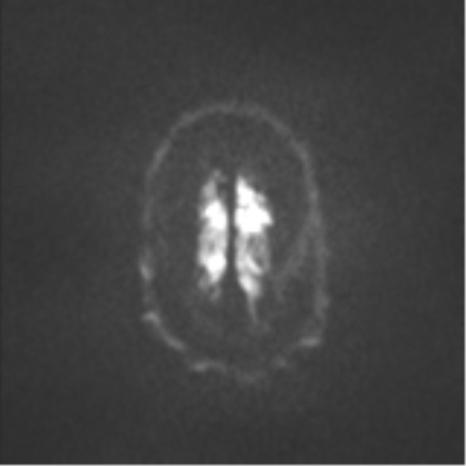 Colloid cyst (Radiopaedia 44510-48181 Axial DWI 54).png