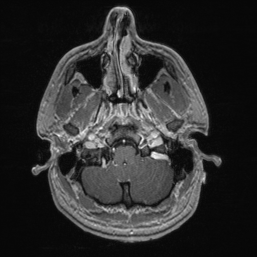 File:Colloid cyst (Radiopaedia 44510-48181 Axial T1 C+ 36).png