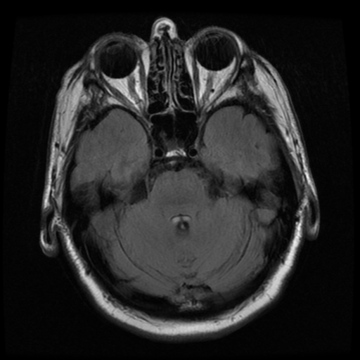 File:Colloid cyst (large) (Radiopaedia 34415-35729 Axial FLAIR 7).png
