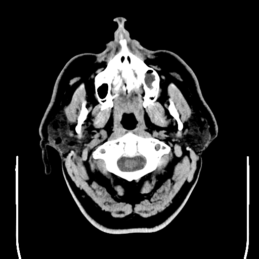 File:Colloid cyst (large) (Radiopaedia 34415-35734 Axial non-contrast 4).png