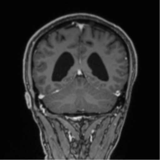 File:Colloid cyst of the third ventricle (Radiopaedia 86571-102662 Coronal T1 C+ 29).png