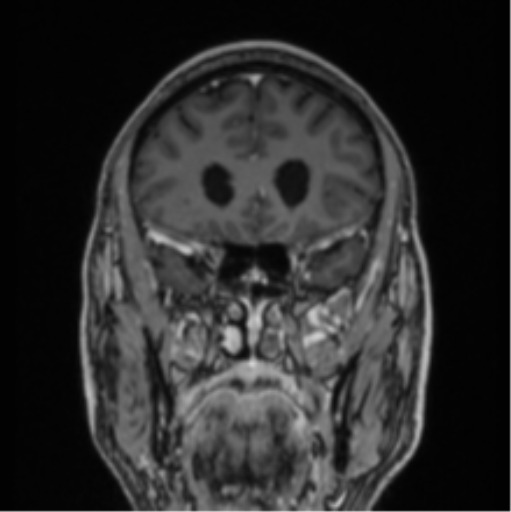 File:Colloid cyst of the third ventricle (Radiopaedia 86571-102662 Coronal T1 C+ 67).png