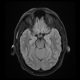 File:Colloid cyst with anterior communicating artery aneurysm (Radiopaedia 33901-35091 Axial FLAIR 9).jpg