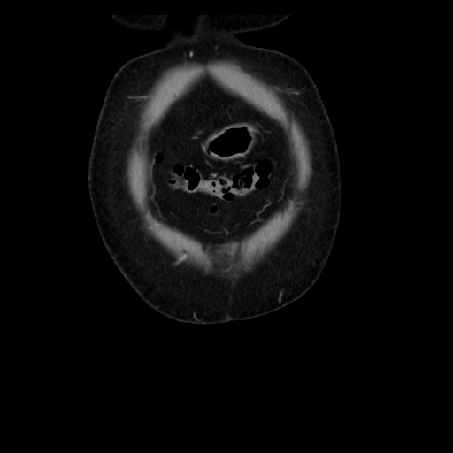 Colocolic intussusception due to tubular adenoma (Radiopaedia 73744-84551 B 19).jpg