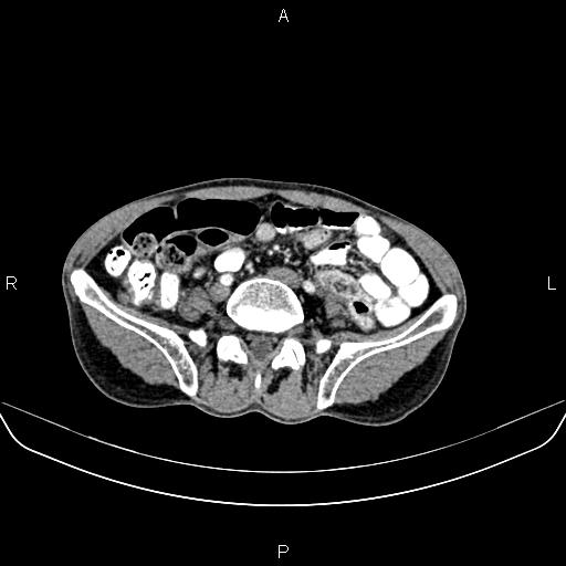 Colon adenocarcinoma - hepatic flexure (Radiopaedia 85635-101395 A 63).jpg