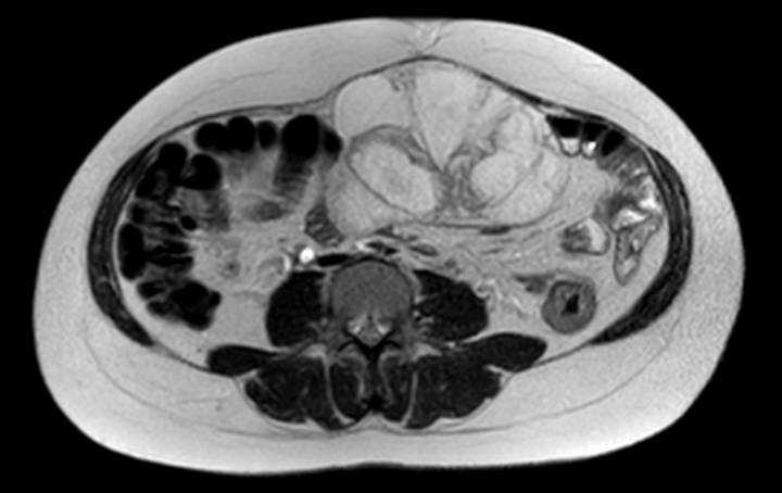File:Colon adenocarcinoma with Krukenberg tumors, advanced pregnancy (Radiopaedia 67279-76645 Axial T2 38).jpg