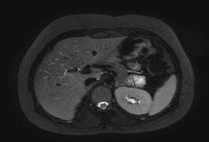 Colon adenocarcinoma with Krukenberg tumors, advanced pregnancy (Radiopaedia 67279-76645 Axial T2 SPAIR 63).jpg