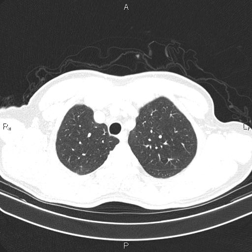 File:Colon cancer (Radiopaedia 85663-101443 Axial lung window 13).jpg