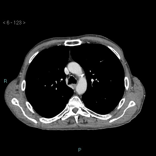 File:Colonic cancer (ultrasound and TC imaging) (Radiopaedia 50346-55713 B 123).jpg