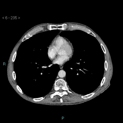 File:Colonic cancer (ultrasound and TC imaging) (Radiopaedia 50346-55713 B 235).jpg
