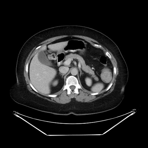 File:Colonic intussusception due to adenocarcinoma (Radiopaedia 86828-102987 A 47).jpg