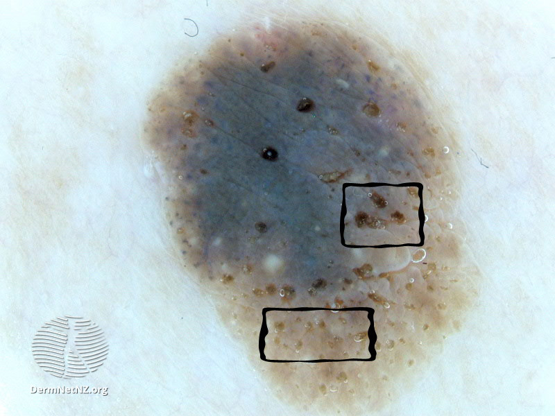 File:Dermatoscopy of seborrhoeic keratosis. Rectangles highlight comedones. (DermNet NZ 10-comedo-like-a).jpg