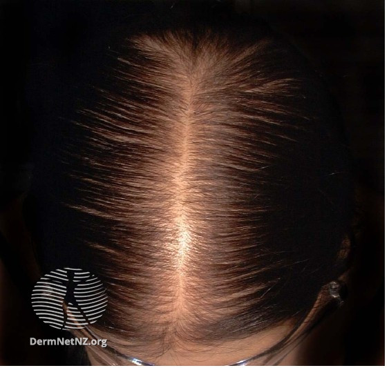 File:Grade 2 hair loss (DermNet NZ fphl1).jpg
