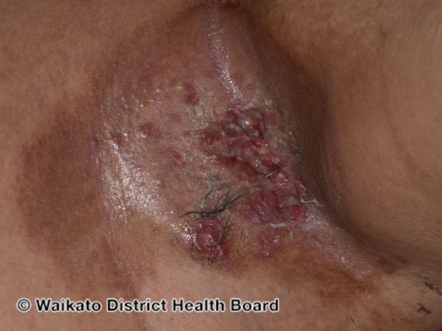 File:Langerhans histiocytosis (DermNet NZ langerhans-histiocytosis).jpg