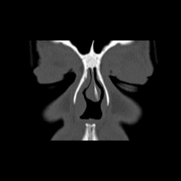 File:Nasal septal perforation (Radiopaedia 25030-25289 Coronal bone window 13).jpg