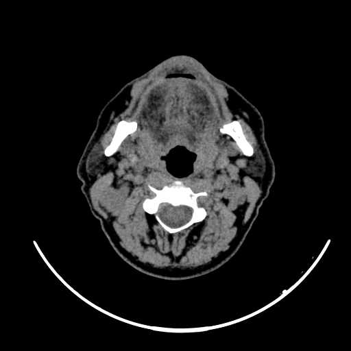 File:Nasopharyngeal carcinoma - infiltrating the clivus (Radiopaedia 62583-70875 Axial non-contrast 32).jpg