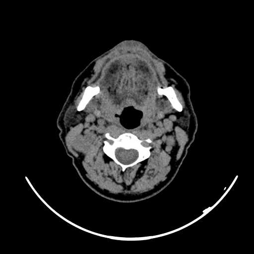 File:Nasopharyngeal carcinoma - infiltrating the clivus (Radiopaedia 62583-70875 Axial non-contrast 33).jpg