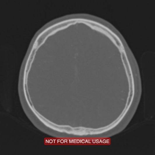 Nasopharyngeal carcinoma recurrence - skull base destruction (Radiopaedia 29107-29490 Axial bone window 33).jpg