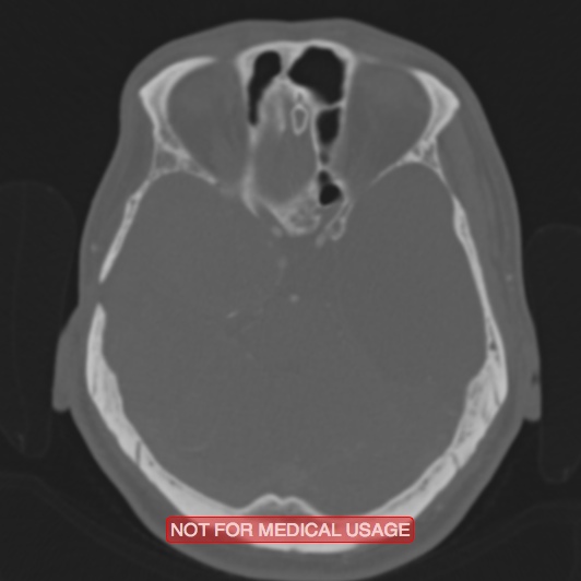 File:Nasopharyngeal carcinoma recurrence - skull base destruction (Radiopaedia 29107-29490 Axial bone window 70).jpg