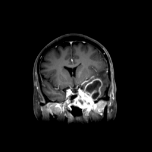 File:Nasopharyngeal carcinoma with cerebral abscess (Radiopaedia 43018-46274 L 24).png