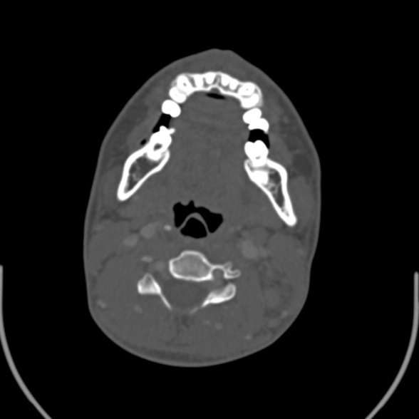 File:Nasopharyngeal carcinoma with skull base invasion (Radiopaedia 53415-59705 Axial bone window 108).jpg