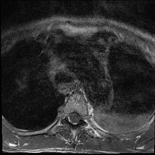 File:Nasopharyngeal carcinoma with skull base invasion (Radiopaedia 59258-66600 Axial T1 35).jpg