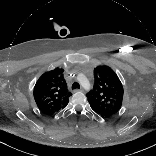 Neck CT angiogram (intraosseous vascular access) (Radiopaedia 55481-61945 B 59).jpg