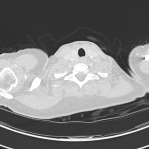 Necrobiotic pulmonary nodules - Crohn disease (Radiopaedia 20723-20631 Axial lung window 5).jpg