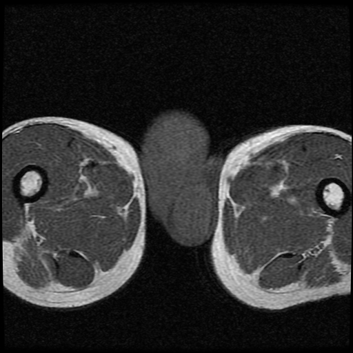 File:Necrotizing epididymo-orchitis with intra-testicular abscess (Radiopaedia 29397-29860 Axial T1 16).jpg
