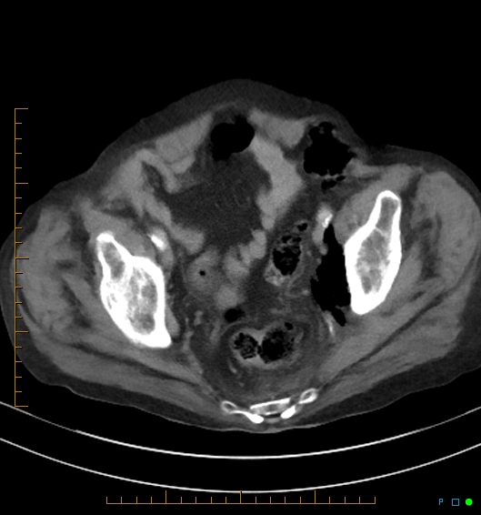 Necrotzing fasciitis due to a perforated adenocarcinoma of the splenic flexure (Radiopaedia 46930-51455 A 55).jpg