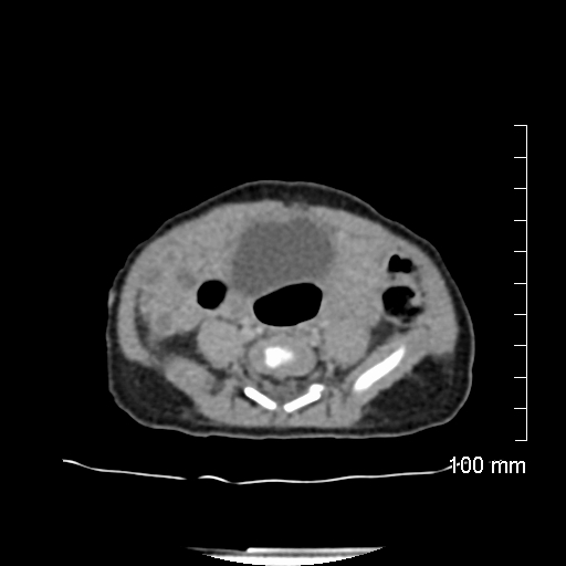 File:Neonatal neuroblastoma (Radiopaedia 56651-63438 Axial non-contrast 58).jpg