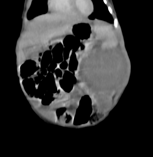Nephroblastomatosis (Radiopaedia 71294-81607 B 98).jpg