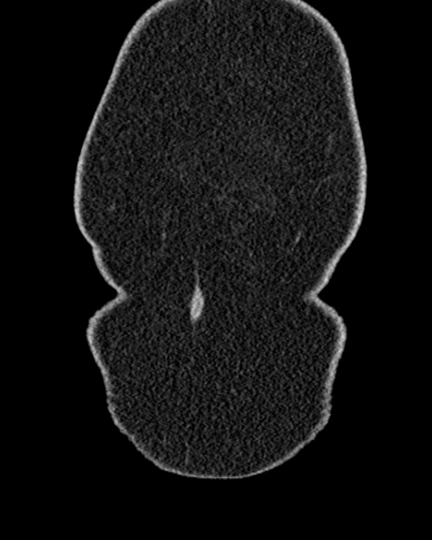 File:Nephrostomy for urosepsis (Radiopaedia 26180-26330 non-contrast 4).jpg
