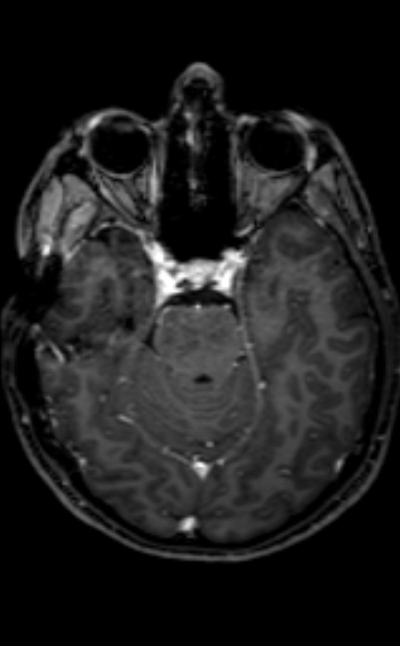 Neuro-Behçet disease (Radiopaedia 90112-107294 Axial T1 C+ 155).jpg