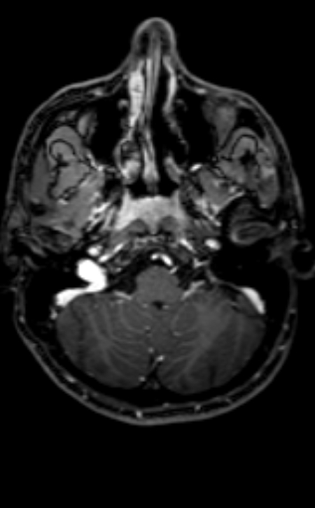 Neuro-Behçet disease (Radiopaedia 90112-107294 Axial T1 C+ 180).jpg