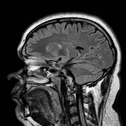 File:Neuro-Behcet's disease (Radiopaedia 21557-21506 Sagittal FLAIR 22).jpg