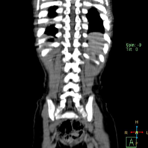 File:Neuroblastoma (Radiopaedia 24751-25016 B 22).jpg