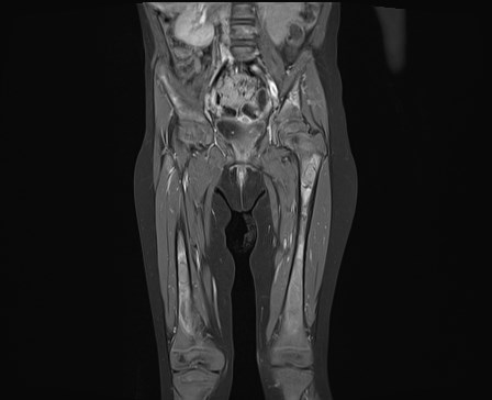 File:Neuroblastoma with bone metastases (Radiopaedia 67080-76414 E 11).jpg
