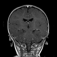 File:Neurofibromatosis type 1 (Radiopaedia 30089-30671 Coronal T1 C+ 17).jpg