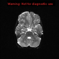 File:Neurofibromatosis type 1 with optic nerve glioma (Radiopaedia 16288-15965 Axial DWI 16).jpg