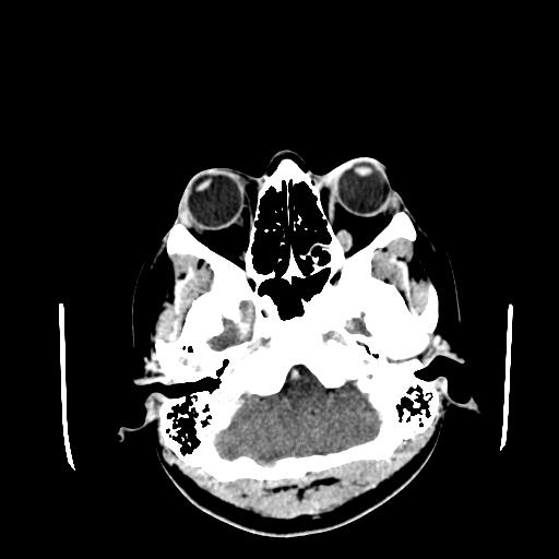 File:Neurofibromatosis type 2 (Radiopaedia 25389-25637 Axial C+ 10).jpg