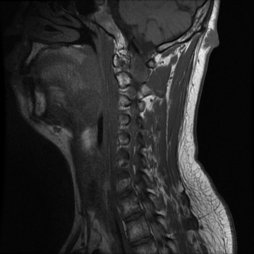 File:Neurofibromatosis type 2 (Radiopaedia 44936-48837 Sagittal T1 6).png