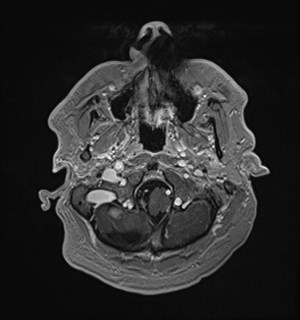 Neurofibromatosis type 2 (Radiopaedia 79097-92049 Axial T1 C+ 33).jpg