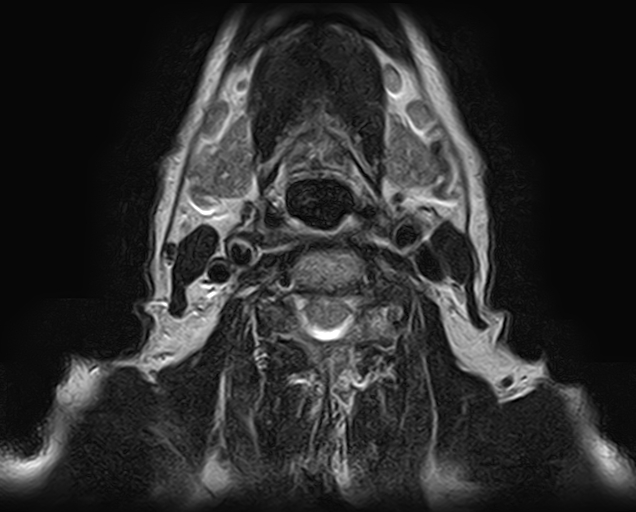 File:Non-Hodgkin lymphoma - parotid gland (Radiopaedia 71531-81890 Axial T2 4).jpg