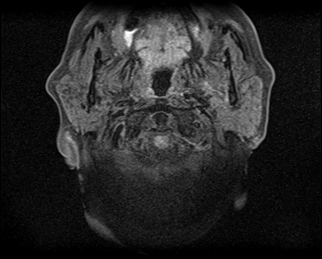 File:Non-Hodgkin lymphoma - parotid gland (Radiopaedia 71531-81890 T1 fat sat 16).jpg